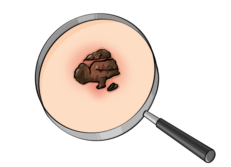 Eine Lupe mit einem Stück vergrößerter Haut. Auf der Haut ist eine unregelmäßige, dunkelbraune Erhebung.