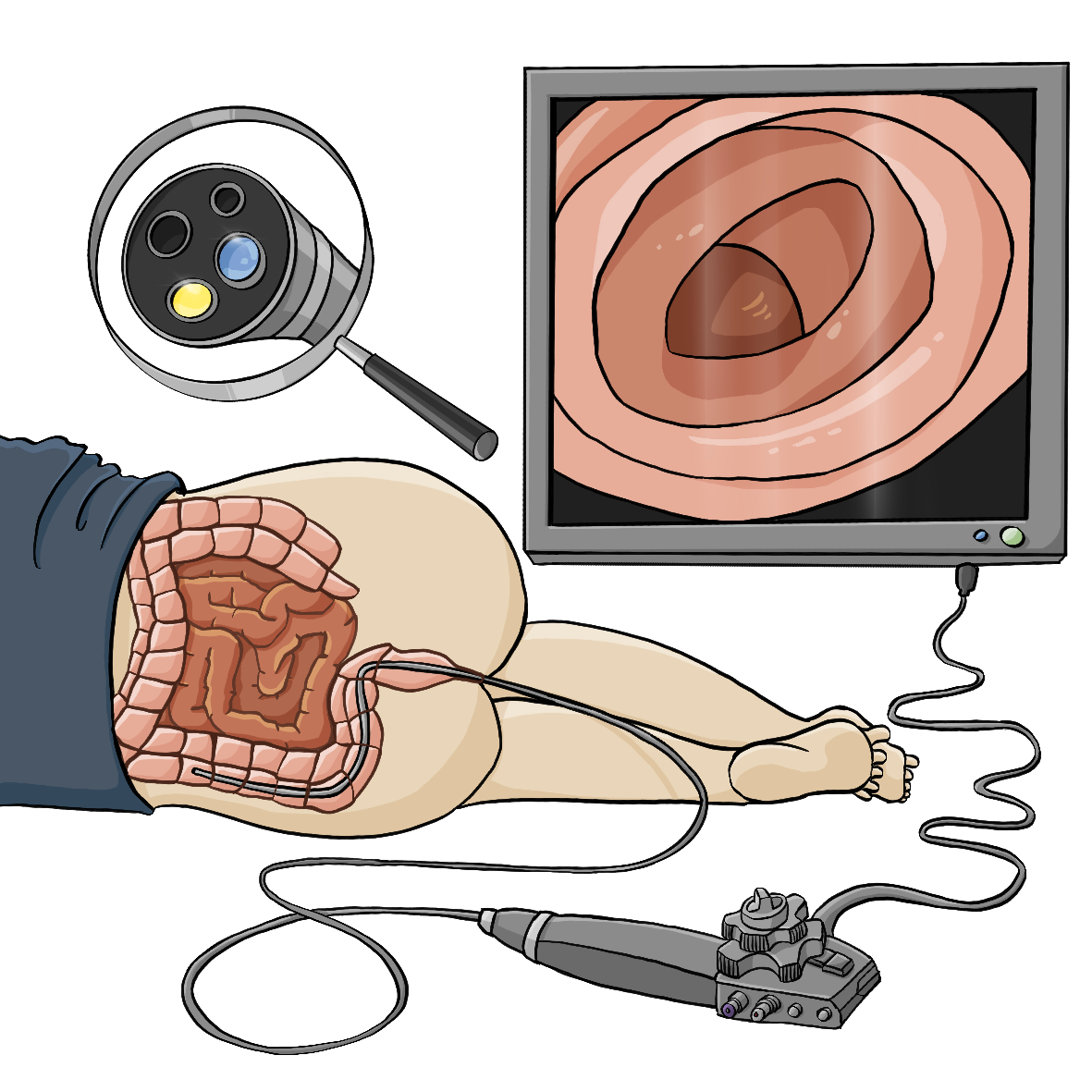 Spar-Paket Darm-Krebs