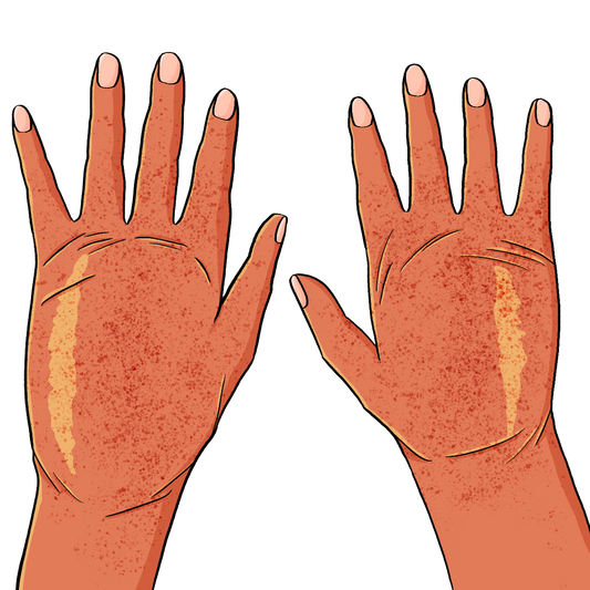Zwei geschwollene Hände. Die Haut ist fleckig und gerötet.