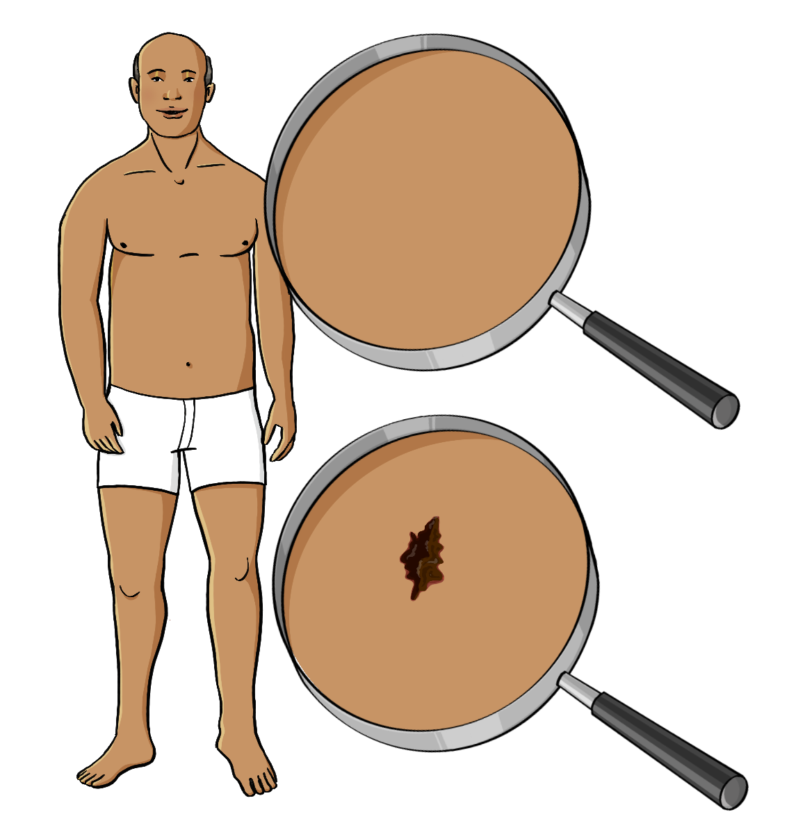Ein Mann, nur mit einer Unterhose bekleidet. Neben dem Bild sind zwei Lupen mit vergrößerter Haut. In der unteren Lupe ist ein dunkelbrauner Fleck auf der Haut.  