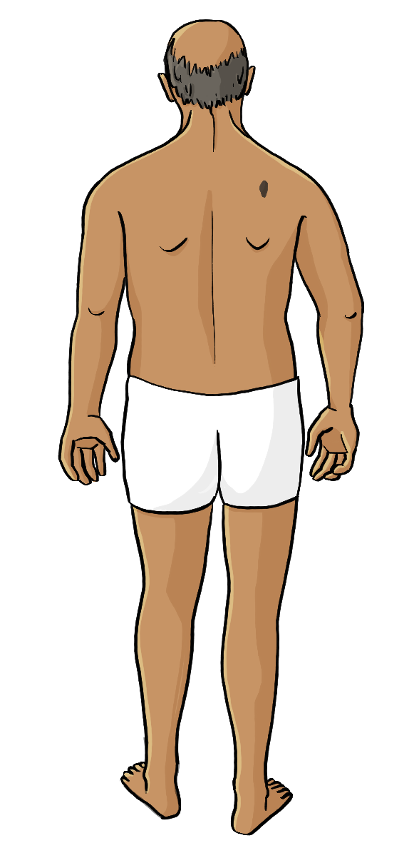 Eine Rückenansicht von einem Mann in Unterhose. Auf seiner linken Schulter ist ein brauner Fleck.