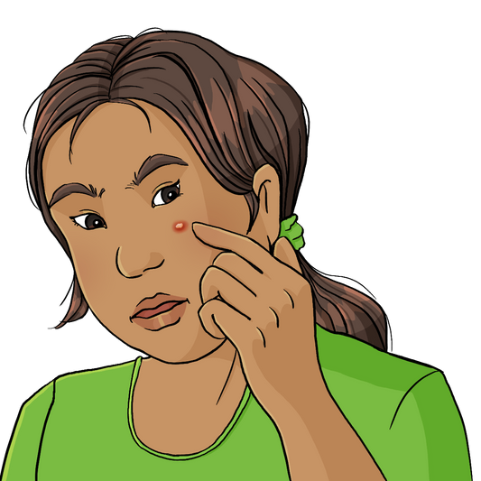 Ein Frauengesicht. Unter dem linken Auge ist ein roter Pickel. Die Frau zeigt auf den Pickel.