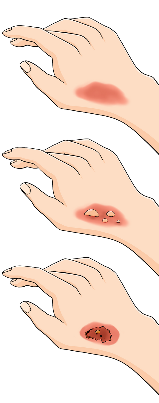 Drei Hände untereinander. Auf der obersten Hand ist ein hellroter Fleck. Auf der mittleren Hand ist ein roter Fleck mit gelben Bläschen. Auf der Unteren Hand ist ein dunkelroter Fleck mit dunklen Rändern.