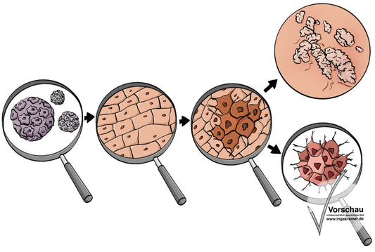 Vergrößerte Zellen unter Lupen: Ein Virus, gesunde Haut, veränderte Haut, Warzen und Krebszellen.