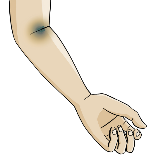 Ein Unterarm. In der Armbeuge ist ein blauer Fleck.