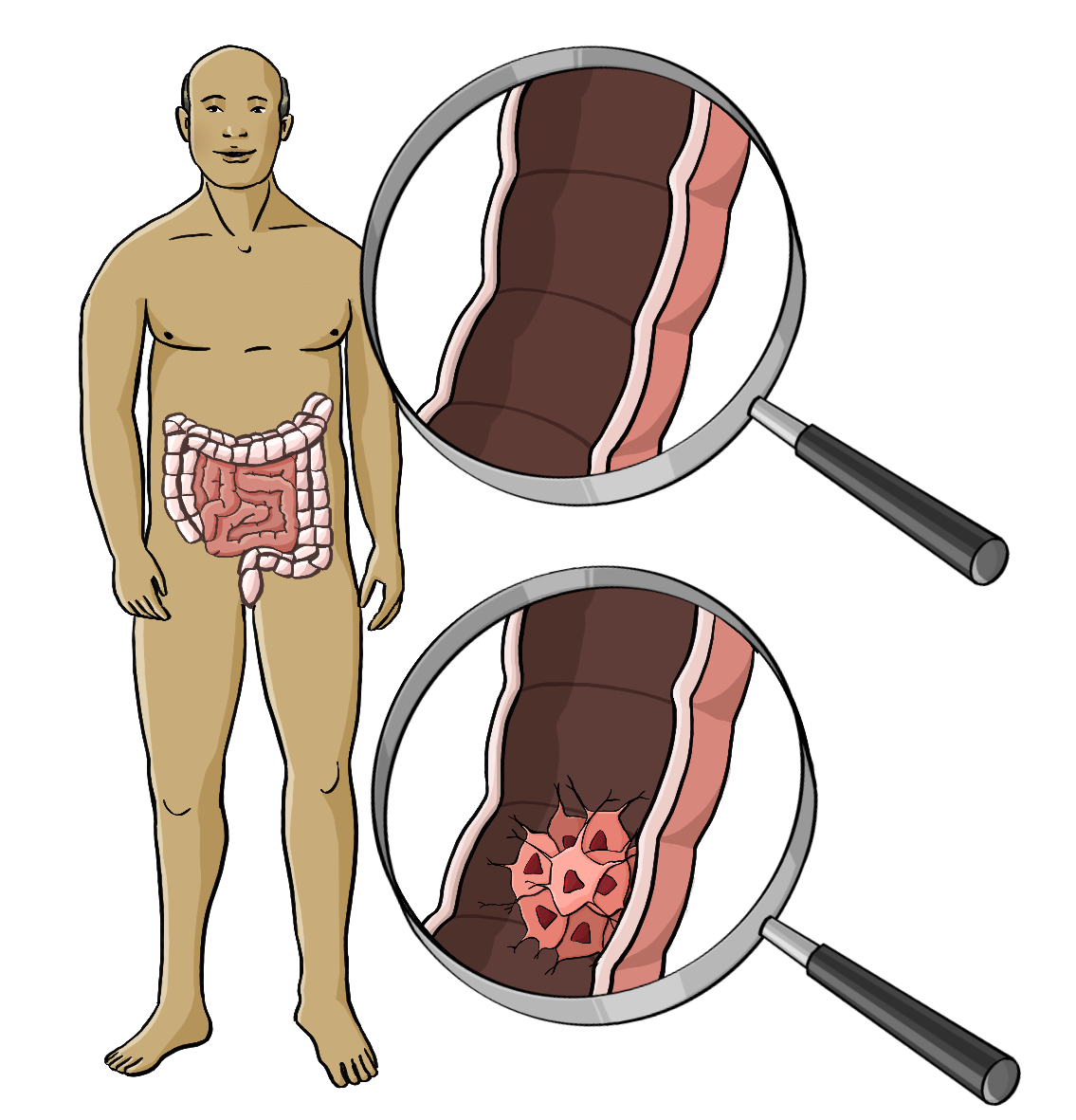 Ein nackter Mann. Im unteren Bauchraum ist der Darm abgebildet. Neben dem Bild sind zwei Lupen mit Darmquerschnitten. Im unteren Darm ist ein Tumor. Im oberen nicht.