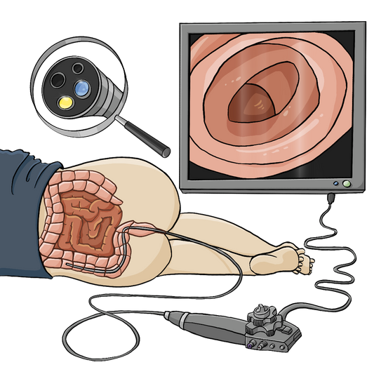 Eine Person liegt auf der Seite, nur der Teil unterhalb der Hüfte ist dargestellt. Die Person trägt nur ein T-Shirt, im unteren Teil des Rückens ist der Darm abgebildet. Im Vordergrund liegt ein Koloskop, der Schlauch führt in den Darm der Person. Im Hintergrund sind ein Monitor mit der Innenansicht des Darms und eine Lupe mit der Vergrößerung des Schlauchendes. Am Schlauchende ist ein Licht und eine Kamera.