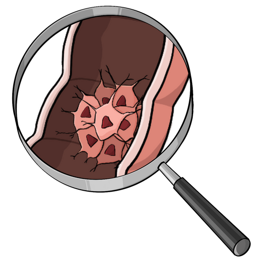 Eine Lupe. Unter der Lupe ist ein Querschnitt von einem Darm mit einer Ansammlung von unregelmäßigen Zellen.