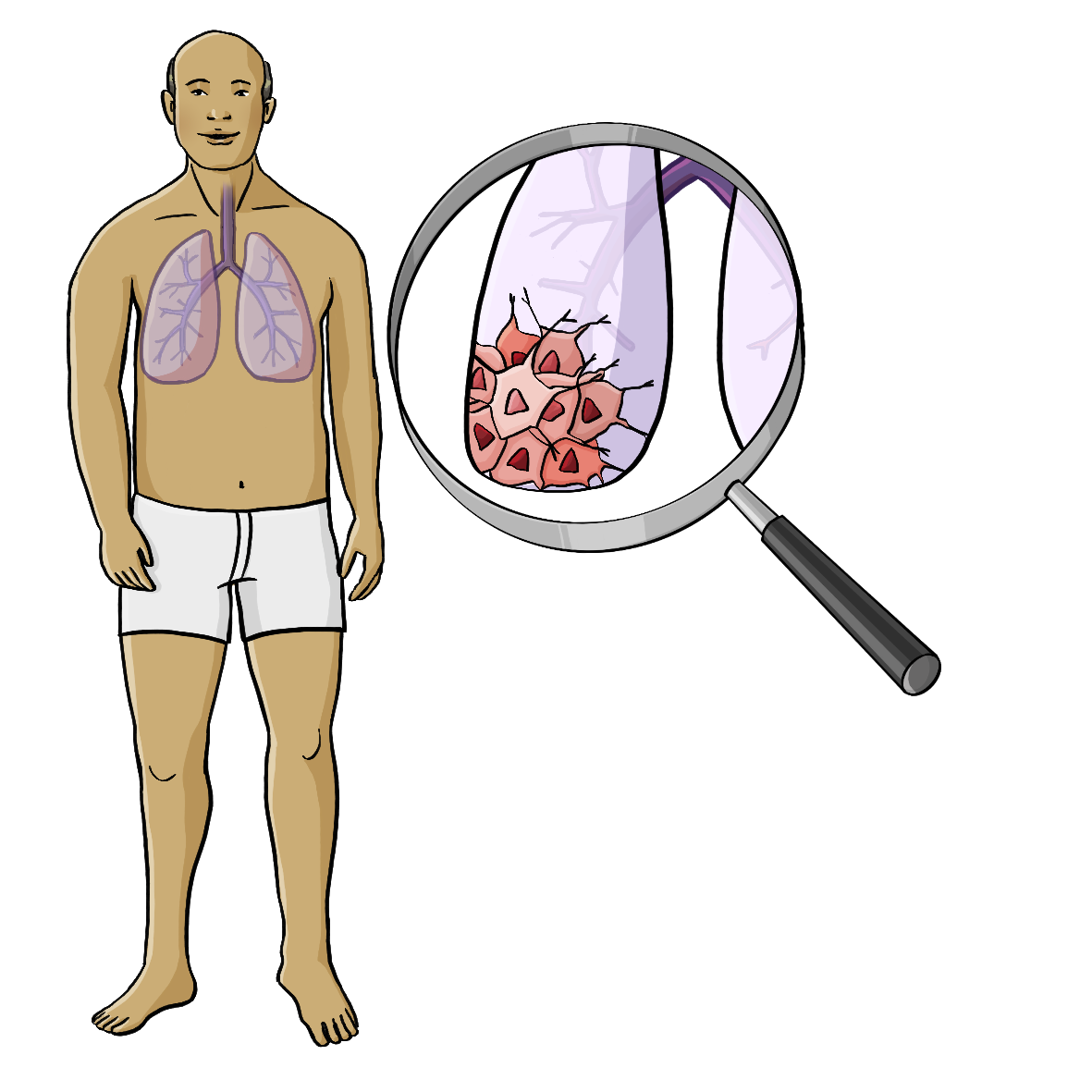 Eine Mann in Unterhose. Im Brustkorb sieht man die Lunge. Neben ihm ist eine große Lupe mit einem vergrößerten Stück Lunge. In der Lunge ist ein Tumor.