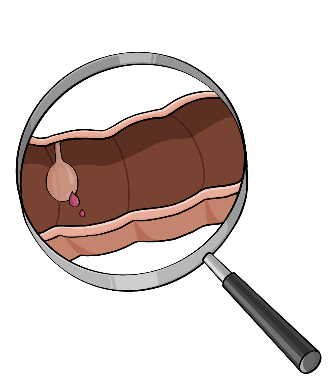 Eine Lupe. Unter der Lupe ist ein Querschnitt von einem Darm. An der oberen Darmwand ist ein runder Knubbel. Unten an dem Knubbel sind drei rote Tropfen.