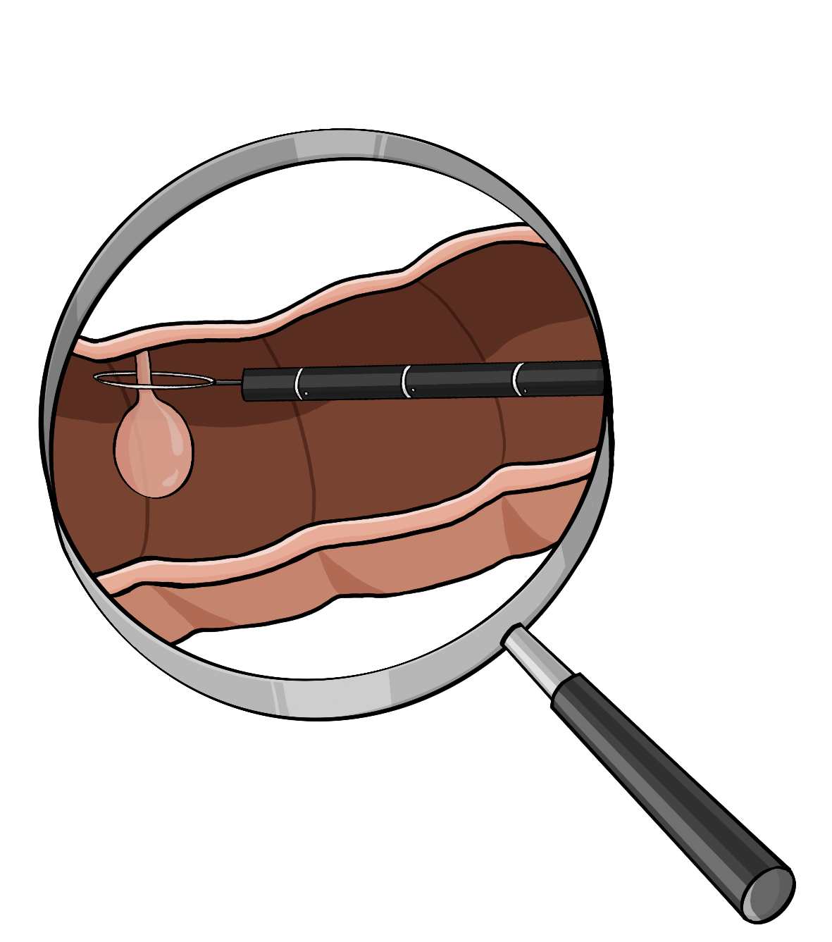 Eine Lupe. Unter der Lupe ist ein Querschnitt von einem Darm. An der oberen Darmwand ist ein runder Knubbel. Um den Knubbel liegt eine dünne Schlinge an einem Stab. 