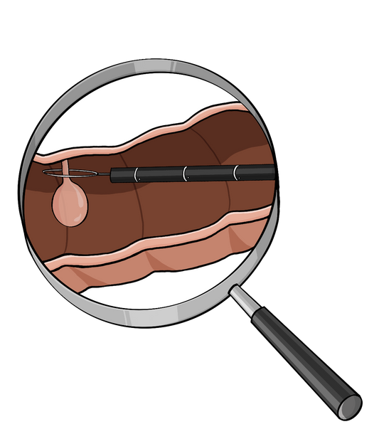 Eine Lupe. Unter der Lupe ist ein Querschnitt von einem Darm. An der oberen Darmwand ist ein runder Knubbel. Um den Knubbel liegt eine dünne Schlinge an einem Stab.