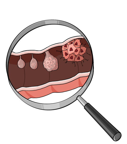 Eine Lupe. Unter der Lupe ist ein Querschnitt von einem Darm. An der oberen Darmwand ist ein runder Knubbel mit glatter Oberfläche. Daneben ist ein etwas größerer Knubbel, unregelmäßiger geformt. Daneben ist ein noch größerer Knubbel mit unregelmäßig geformten Zellen darin. Daneben ist eine große Ansammlung von unregelmäßig geformten Zellen.